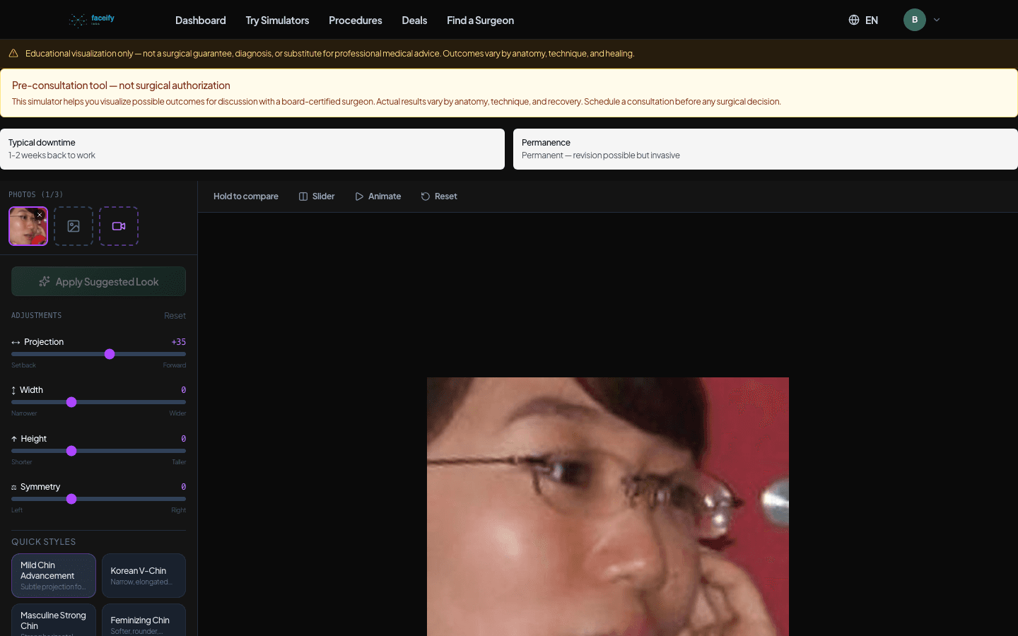 Chin Augmentation — AI Simulation Preview · Fixture 1 — After