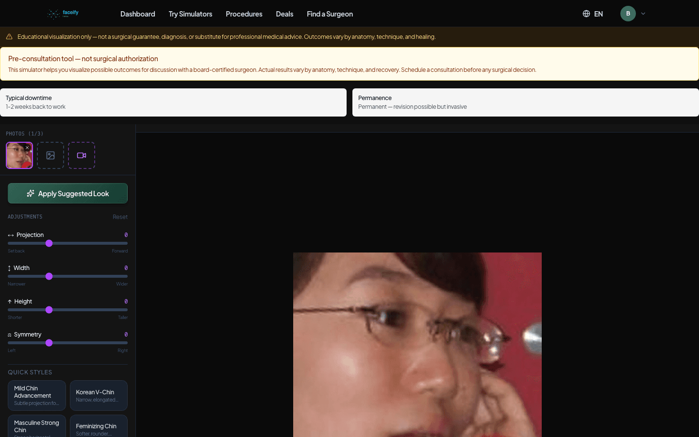 Chin Augmentation — AI Simulation Preview · Fixture 1 — Before