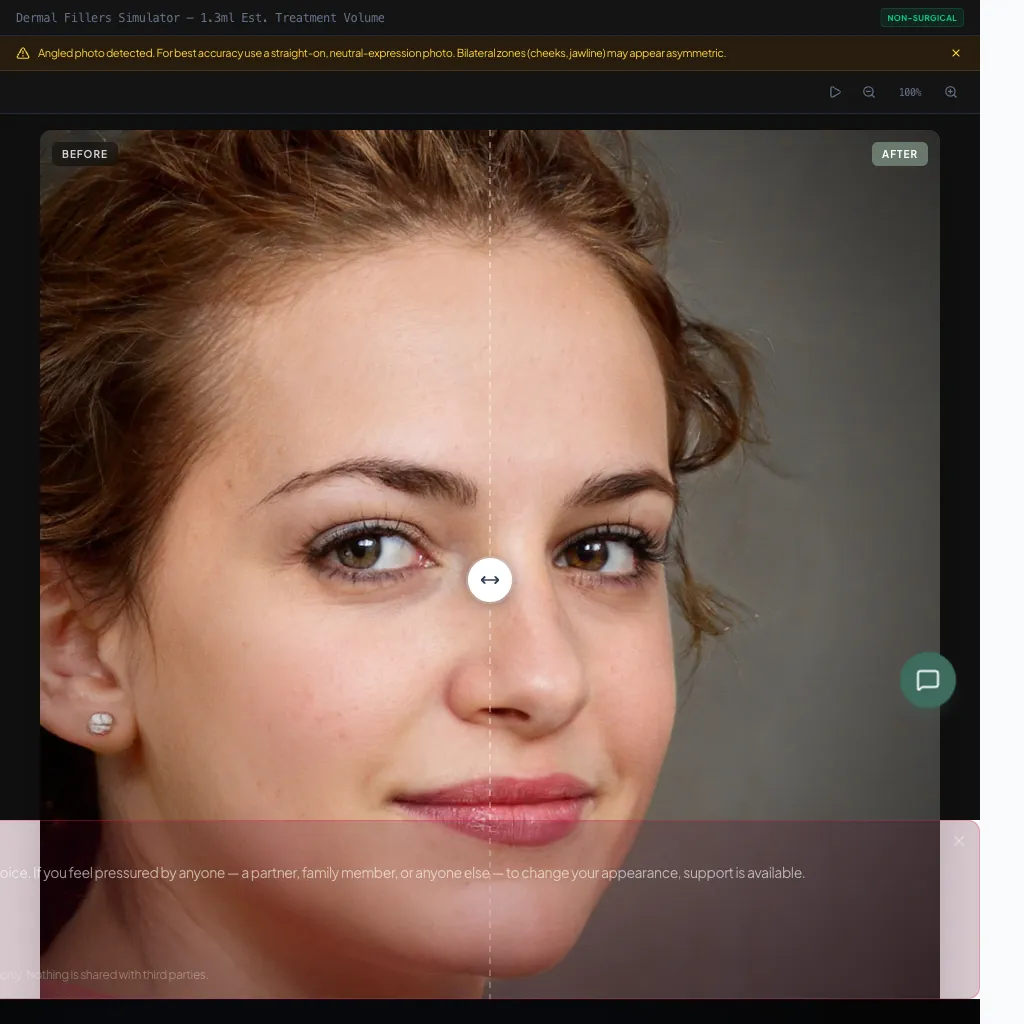 Dermal Fillers — Oblique View — Before