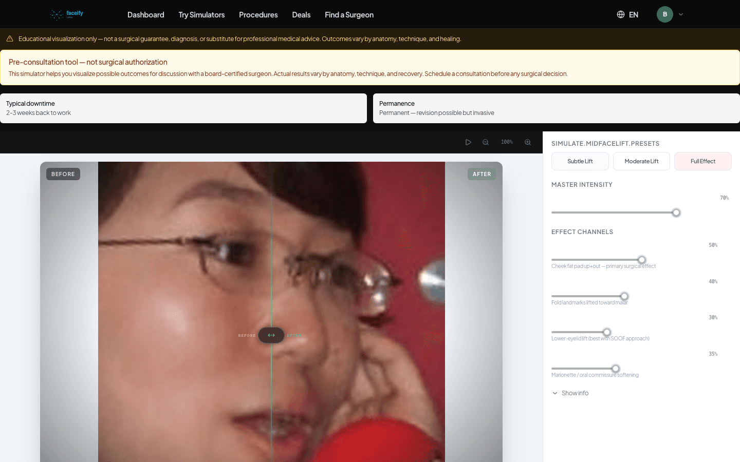 Mid Facelift — AI Simulation Preview · Fixture 1 — After